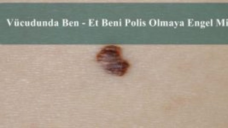 Vücudunda Ben – Et Beni – Nevüs Bekçi Olmaya Engel Mi